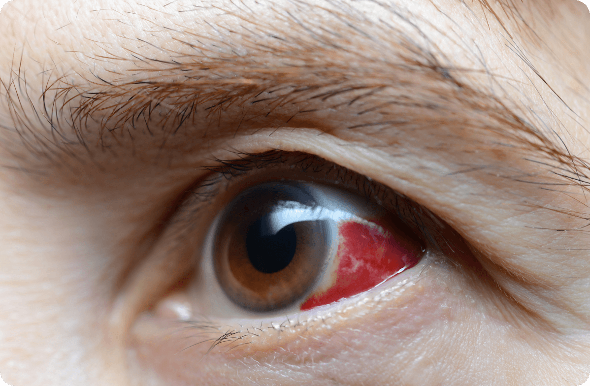 recurrent corneal erosion