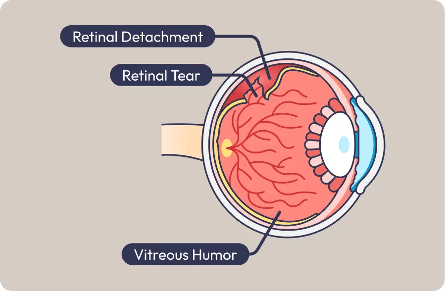 Eagle Eye Centre Singapore diagram of retinal detachment and retinal tear