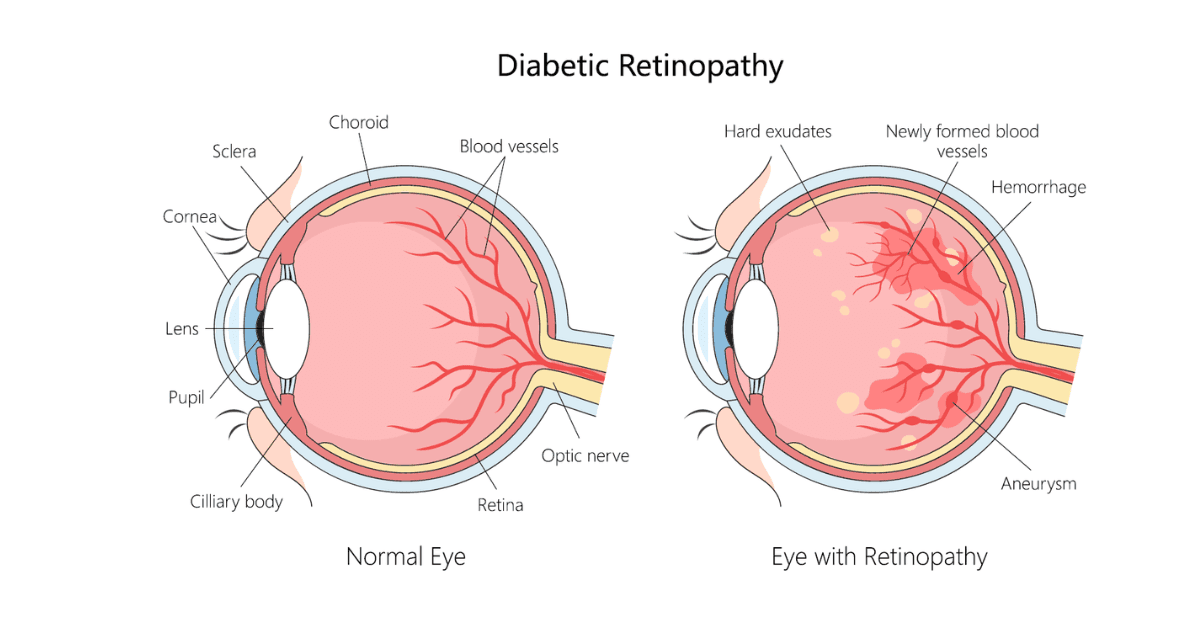 Diabetic retinopathy diagram comparing a normal eye with retinal blood vessel damage, hemorrhage and hard exudates.