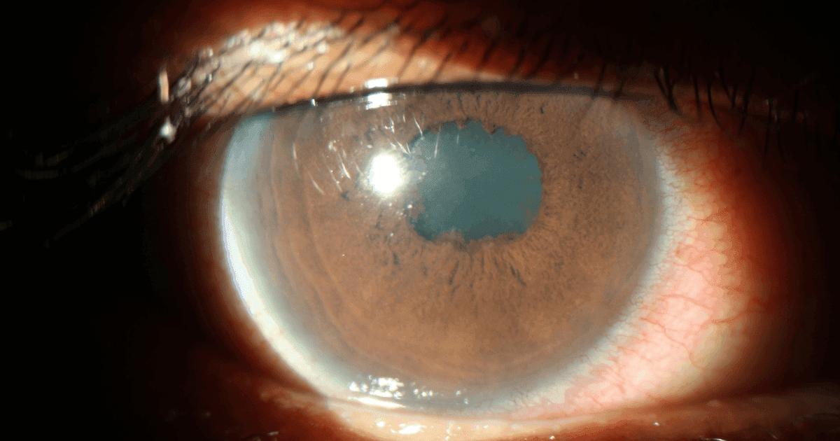 types of ocular inflammation and uveitis