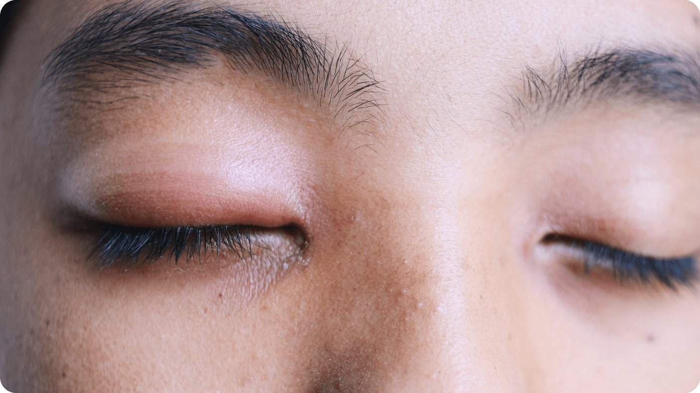 chalazion eyelid swelling and tenderness