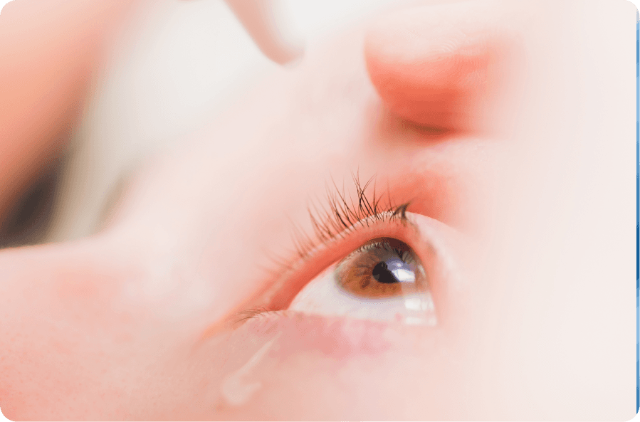 eye with tear showing dryness from mild thyroid eye disease