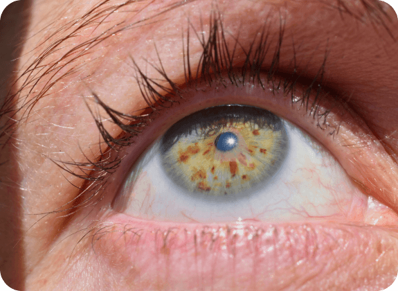 pterygium (surfer’s eye)