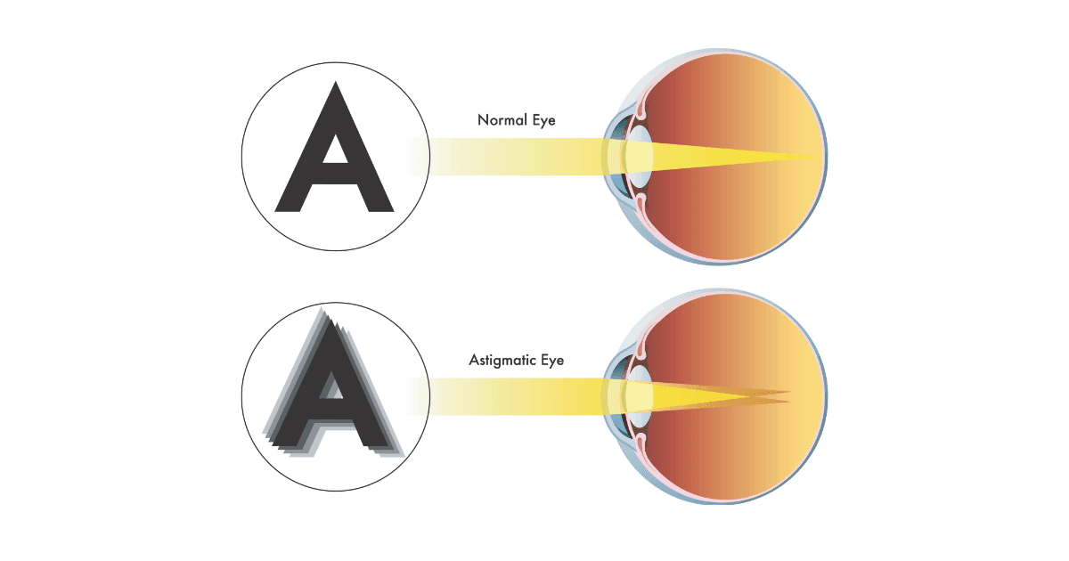 Diagram comparing normal vision and astigmatic vision with uneven light focus