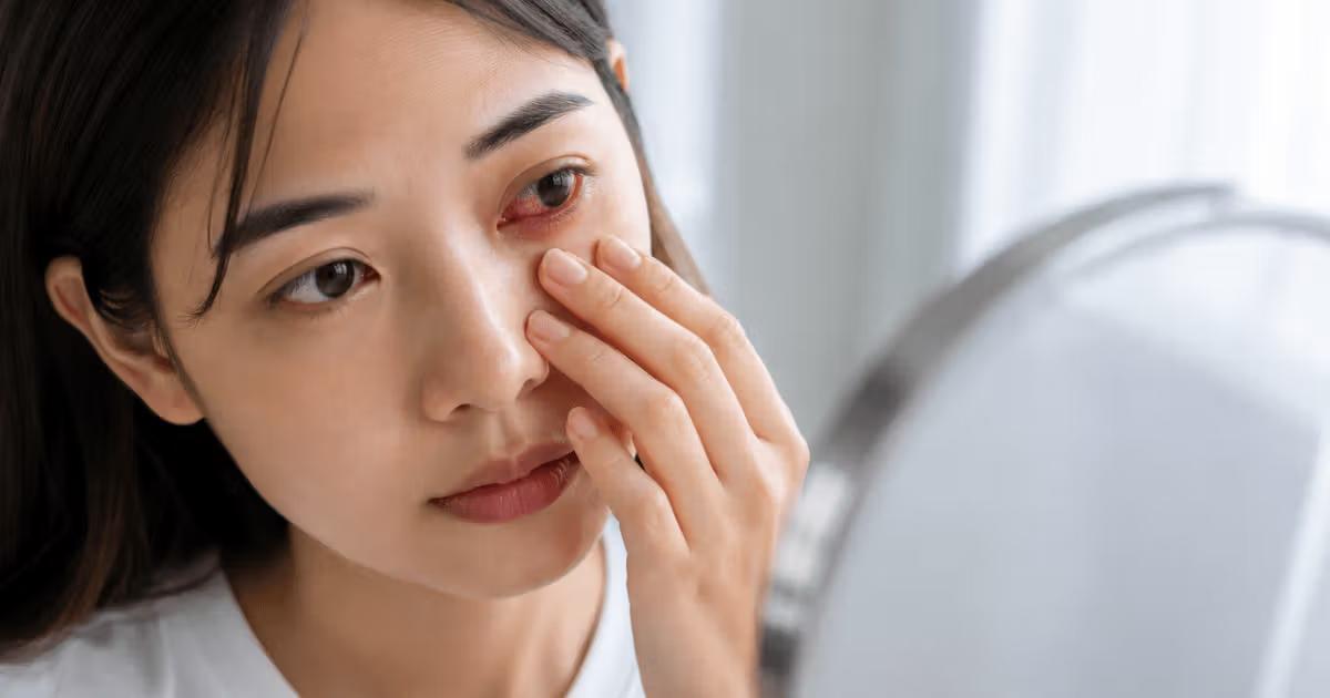 Asian woman with red, irritated eye gently touching her face.