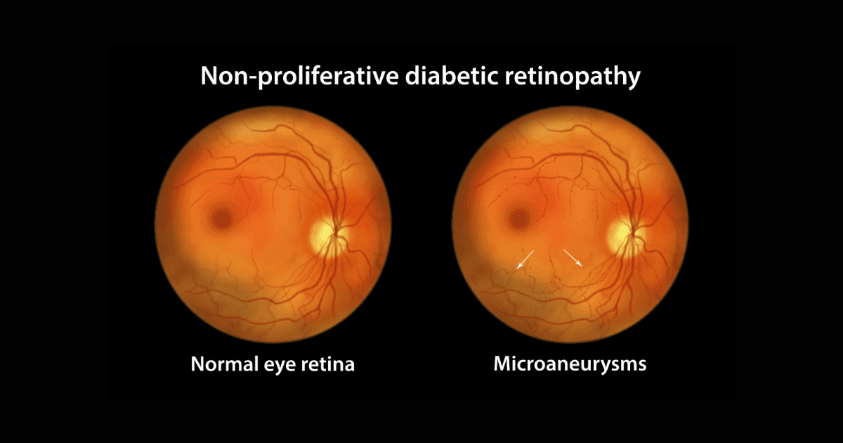 Non-proliferative diabetic retinopathy diagram showing microaneurysms