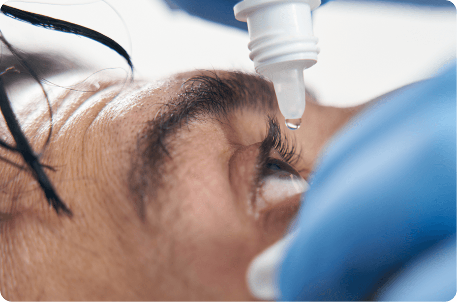 patient receiving eye drops for recurrent corneal erosion treatment