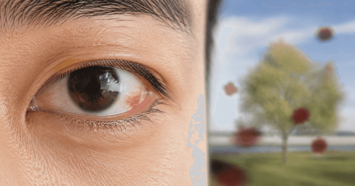 Diabetic retinopathy diagram showing retina damaged by diabetes