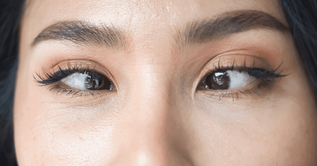 Asian woman with eye misalignment showing symptoms of strabismus or squint.