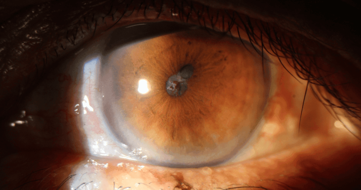 Close-up of eye inflammation and uveitis symptoms