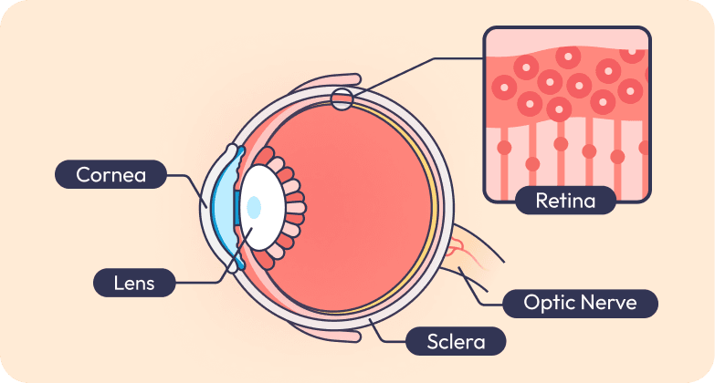 Retinal Detachment