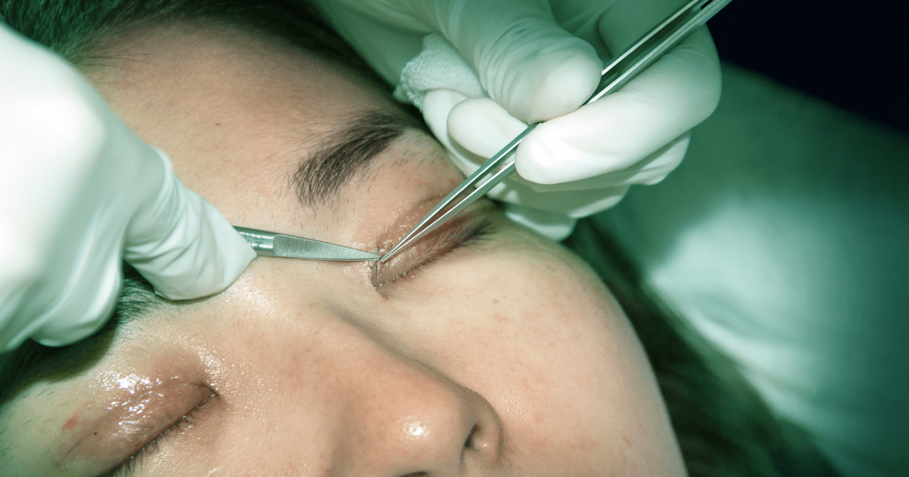 Blepharoplasty Eyelid Surgery | Eagle Eye Centre