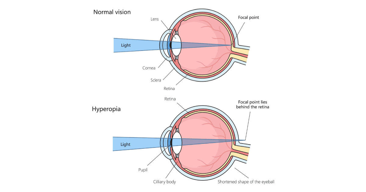 Diagram showing how hyperopia causes light to focus behind the retina instead of directly on it