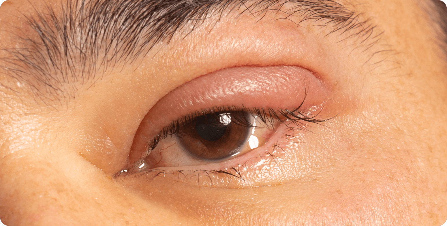 blepharitis diagnosis and eyelid examination