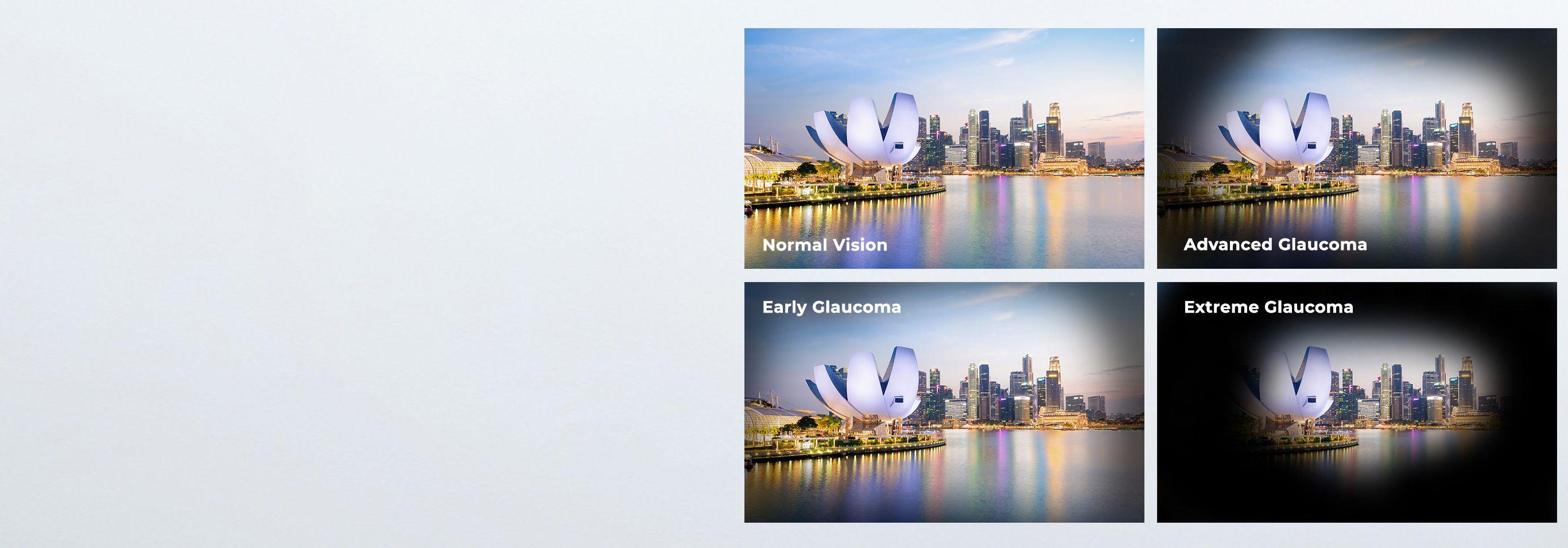 different types of glaucoma