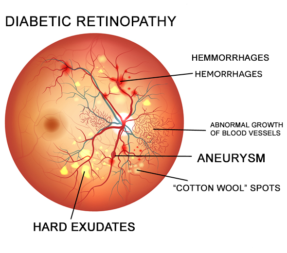 Diabetic Retinopathy Treatment - Eagle Eye Centre